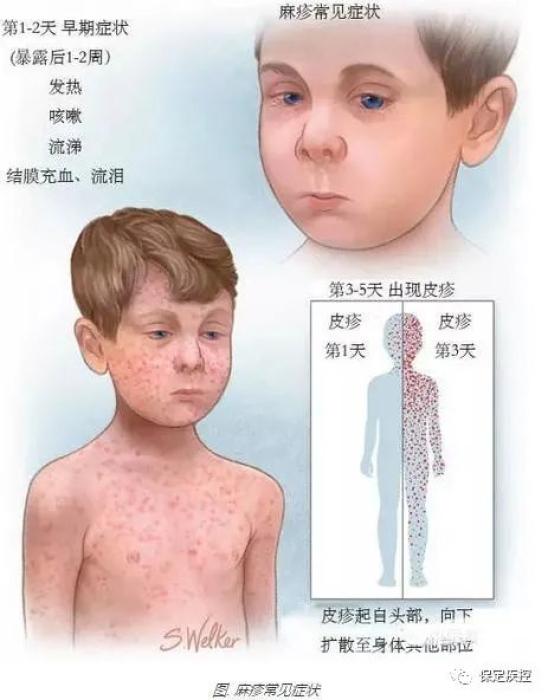 麻疹病毒引起的急性呼吸道传染病,冬春季节高发,通过飞沫传播.