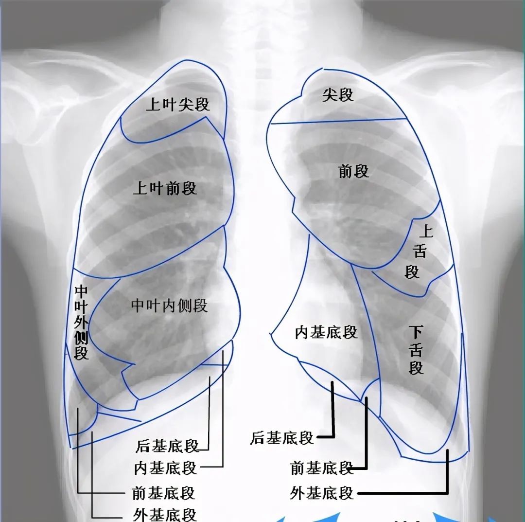 肺部ct图片怎样看懂图片