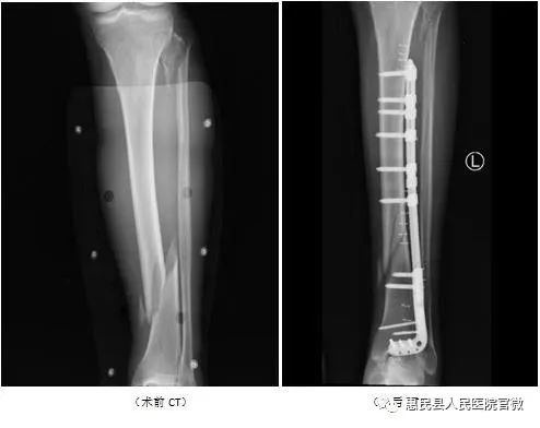 惠民县人民医院完成首例左胫骨骨折闭合复位桥接组合内固定术