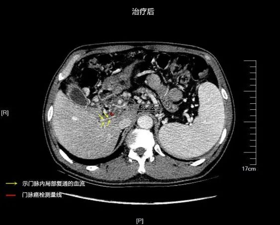 曙光动态我院超声医学中心成功运用高强度聚焦超声hifu治疗门静脉癌栓