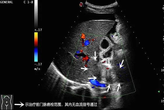 曙光動態我院超聲醫學中心成功運用高強度聚焦超聲hifu治療門靜脈癌栓