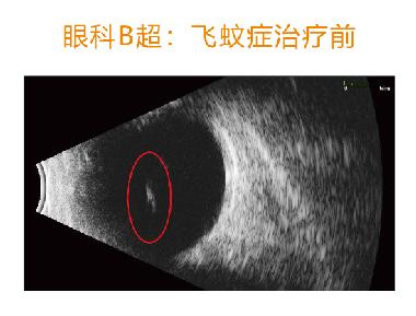 眼底照片黑色阴影是啥图片