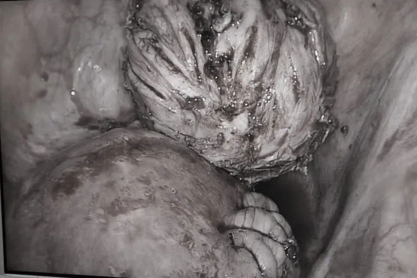 中国医大一院妇科成功完成3例腹腔镜下子宫肌瘤剔除经阴道后穹隆切口