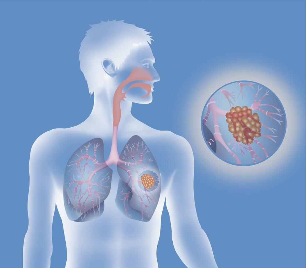 早期肺癌复发转移的风险能够被预测吗