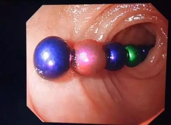 江西2岁男童4处肠穿孔只因家长注意