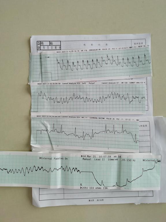 救护车上的心电图,考虑是室速接下来的这套"完美"急救流程,成功让王