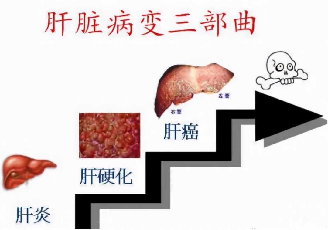 但是如果出现慢性乙肝发病的患者,不能进行及时有效的治疗,慢性肝炎