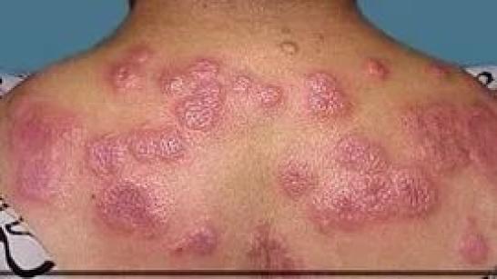 52万人大型数据炎性皮肤病与慢性肾脏疾病风险真的有关联吗