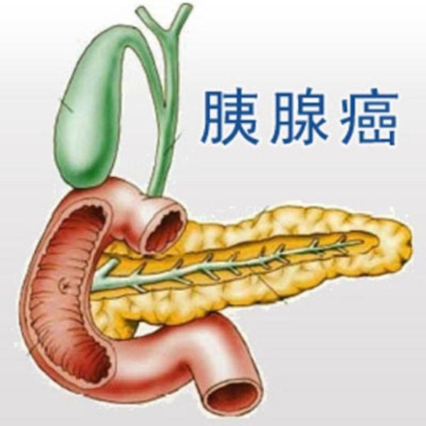 胰头癌晚期无法手术切除,来自山东63岁的王先生求医无门.