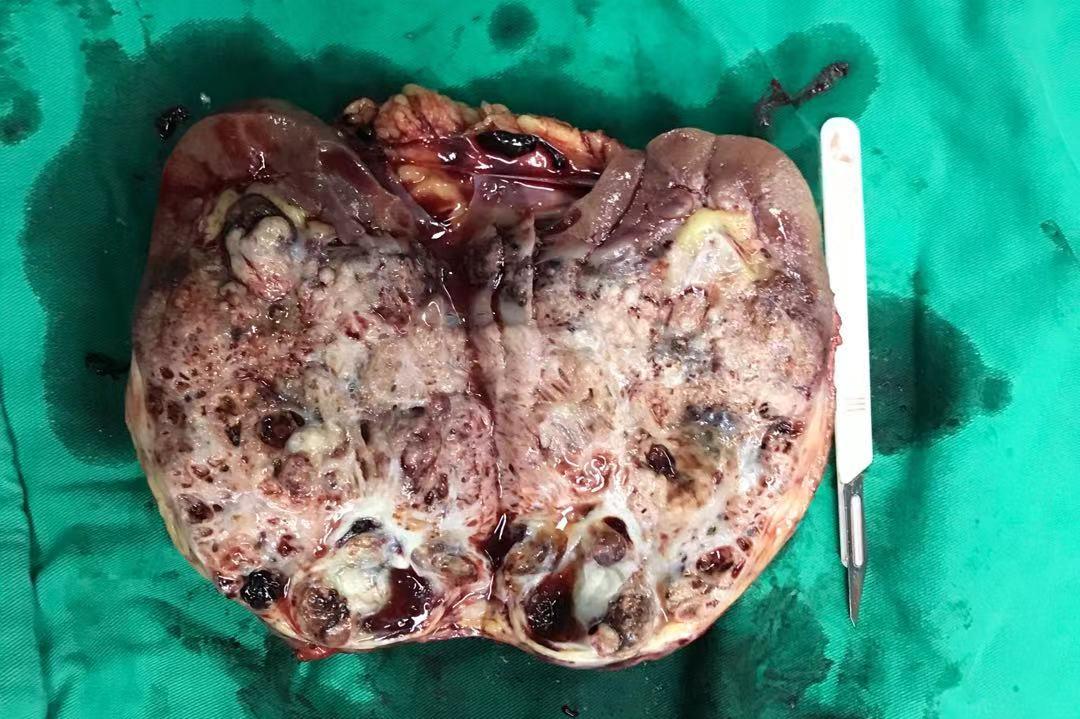 聚焦术业专攻精益求精市六金山分院泌尿外科肾肿瘤亚专业团队出新招