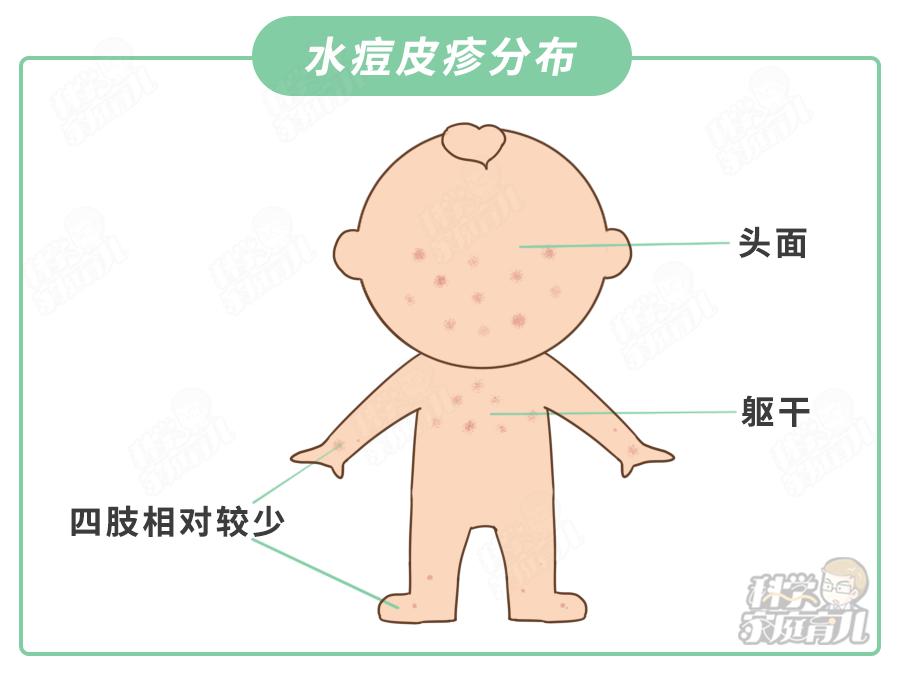 春季水痘爆发22名学生确诊娃出现这种情况赶紧隔离