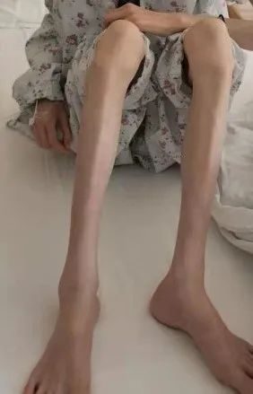 如果因为种种原因导致营养不良,蛋白质缺乏,会引起血清蛋白降低,甚至