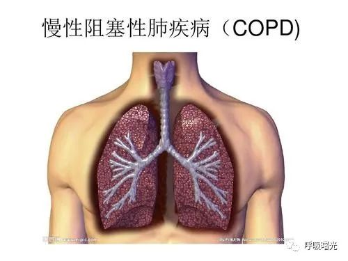 慢性阻塞性肺疾病的防治