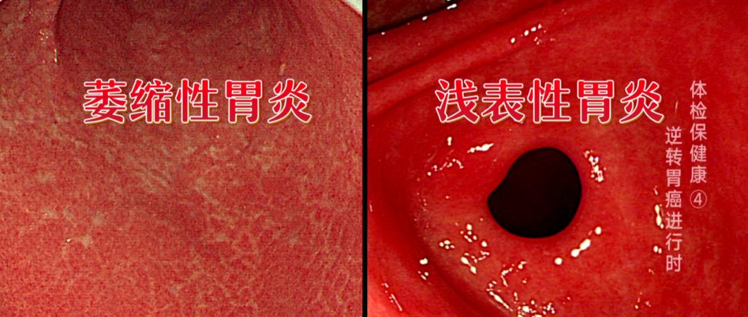 萎缩性胃炎的"萎缩"是指胃黏膜腺体的数量减少了,消化所需的胃酸和胃