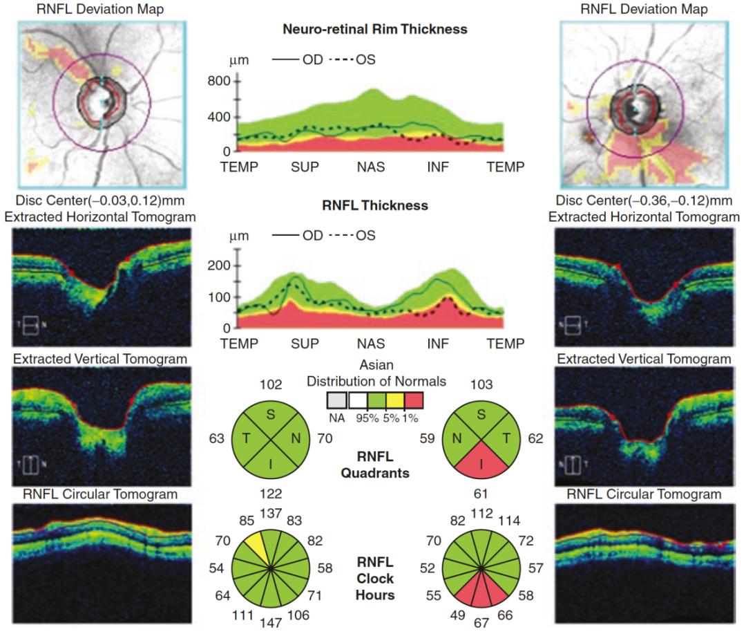 视网膜oct分层图片图片