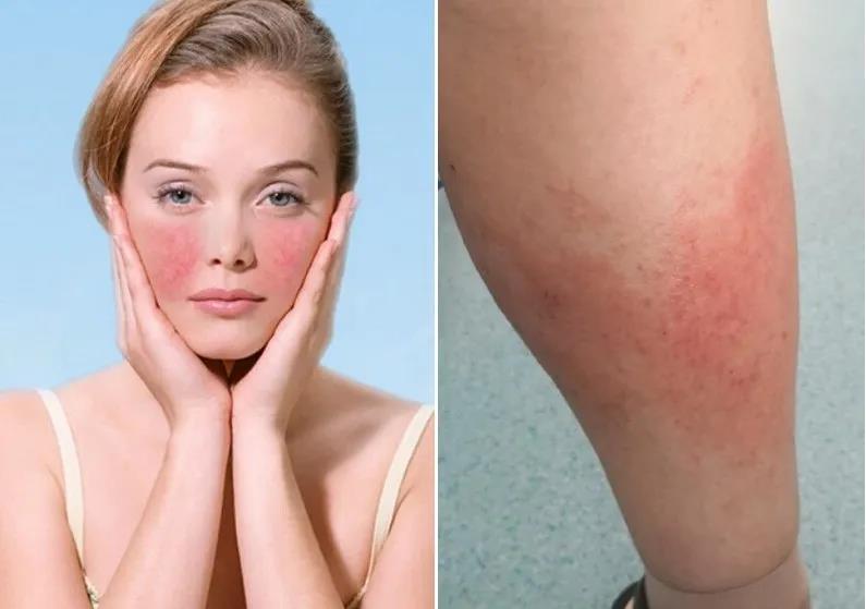 01饮食要注意:饮食问题是接触性皮炎患者最需要注意的问题,要避免吃