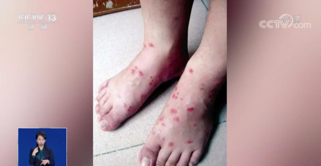 在厦门咬伤市民的蚂蚁也多数为红火蚁几年前在厦门大嶝浔窟社区就发生