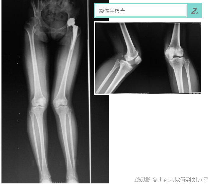 股骨远端截骨保膝不置换