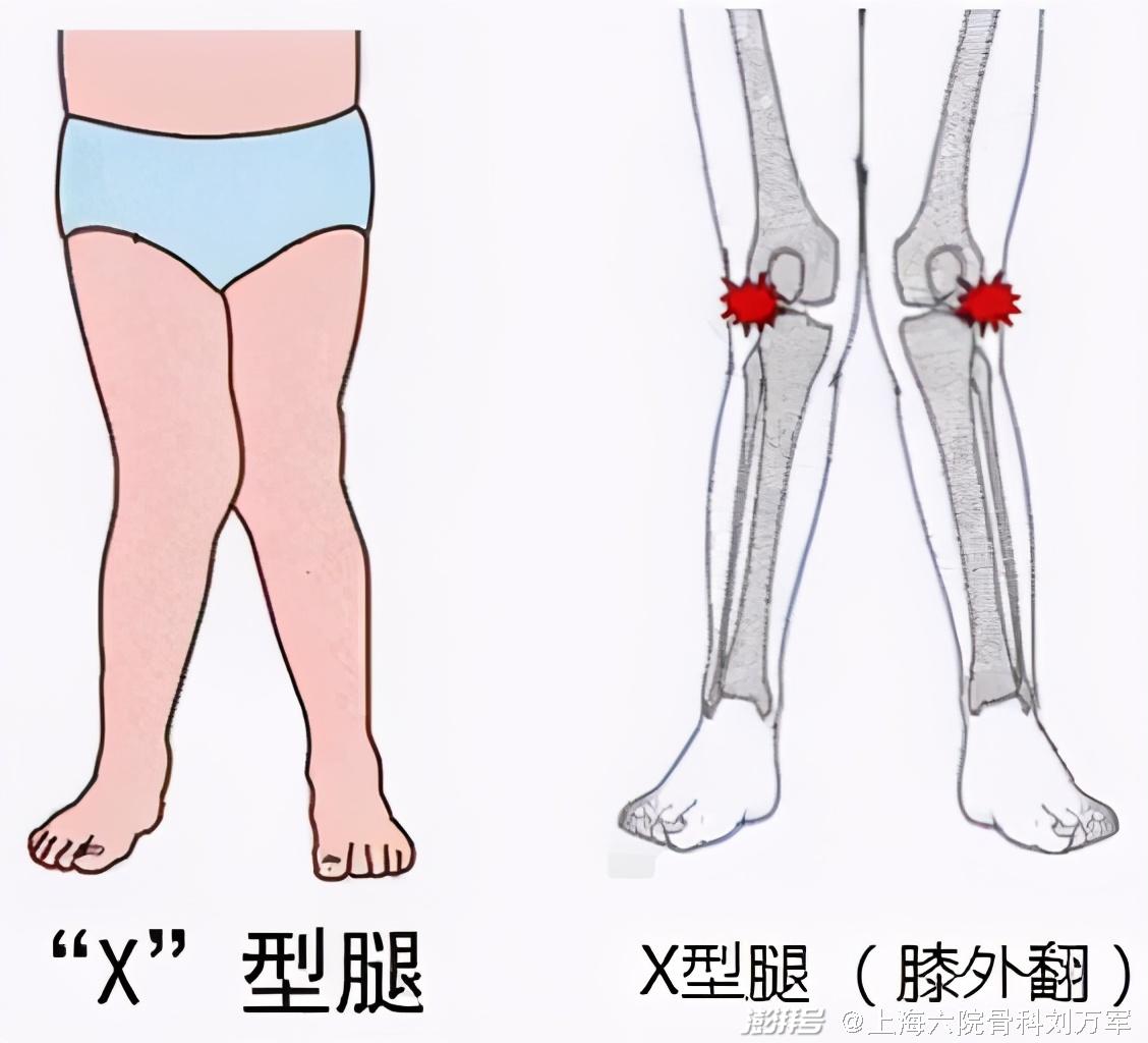 膝外翻破坏了膝关节的正常力线,使膝关节外侧间室所受的应力增大,内侧