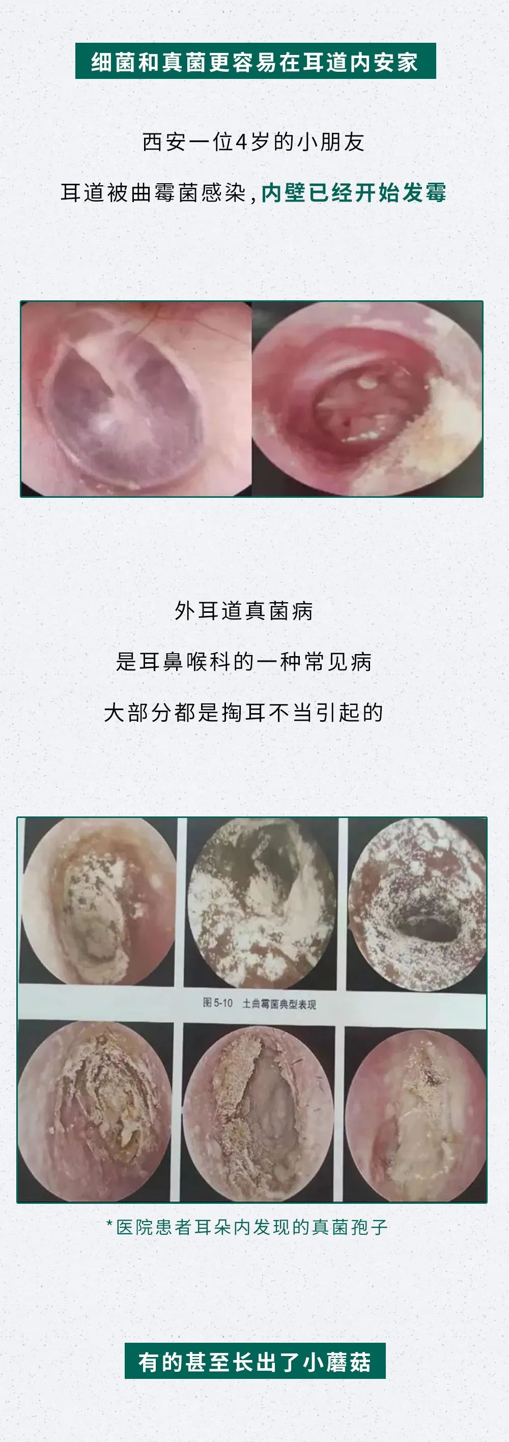 还掏耳屎呢?看看你的耳朵都烂成啥样了