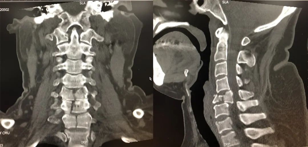 颈椎横突骨折图片