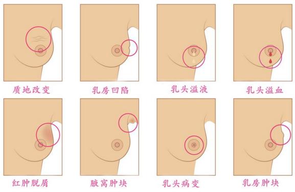 乳腺触诊成像怎么检查手把手教你怎么给自己的乳腺做检查_https://www.jmylbn.com_新闻资讯_第2张