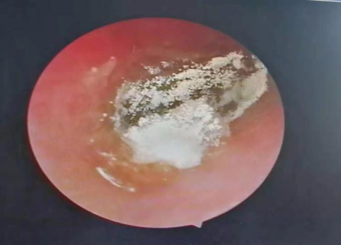 【耳鼻喉诊室】小伙采耳后为啥患上"脚气病"?