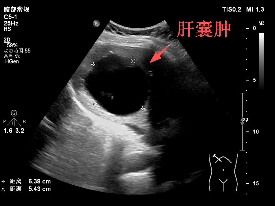 肝囊肿彩超图片
