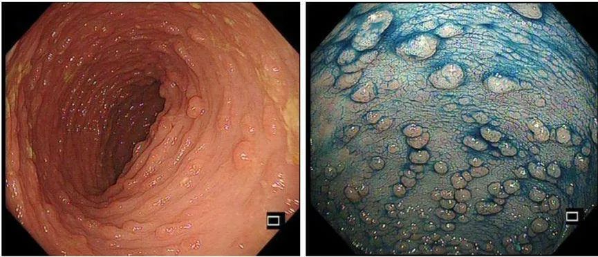 肇庆男子痛悔小小息肉变成直肠癌都怪这事没做好