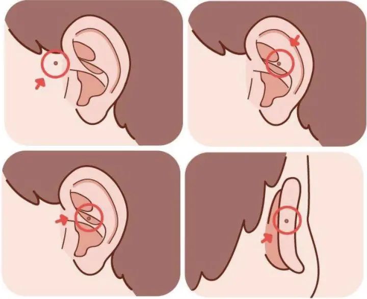 【科普系列】民间俗称的“耳仓”，竟是一种先天性耳疾