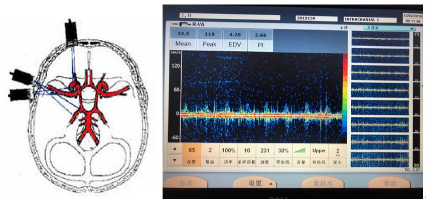 经颅多普勒超声(transcranial doppler,tcd 评估脑血管灌注状态及脑