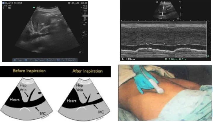 超声测量下腔静脉宽度及变异度评估容量状态和容量反应性膈肌功能评估