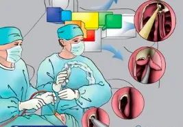 慢性鼻窦炎的鼻内镜微创治疗