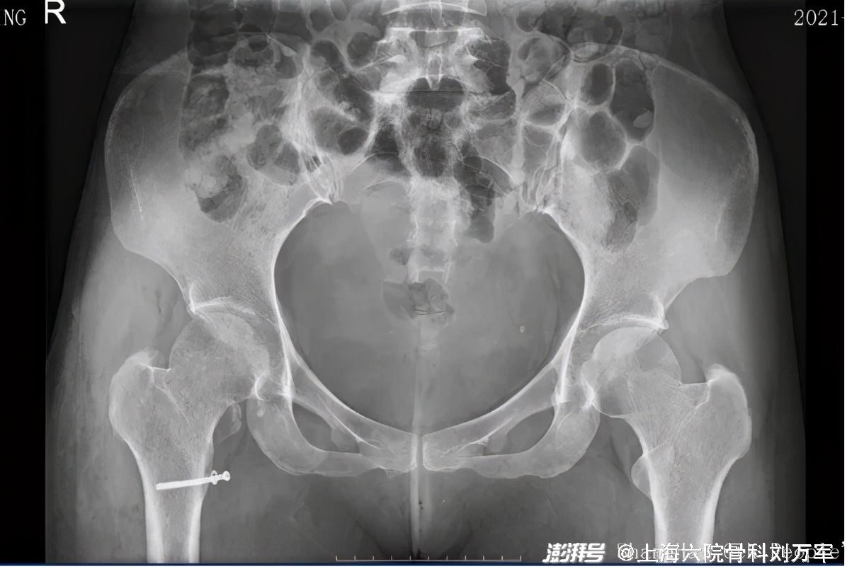 正常的女性骨盆ct图片图片