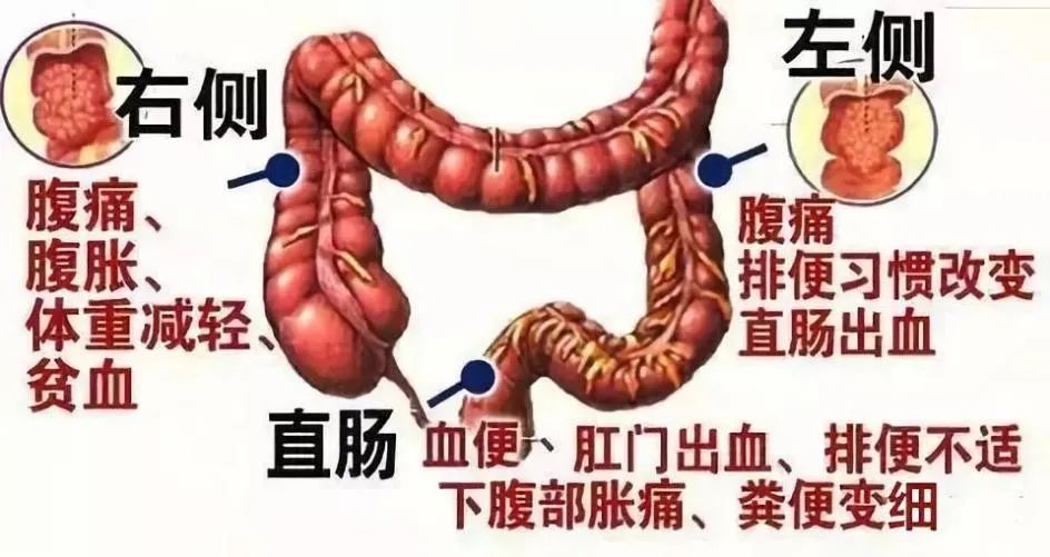 太大意年轻小伙查出直肠癌