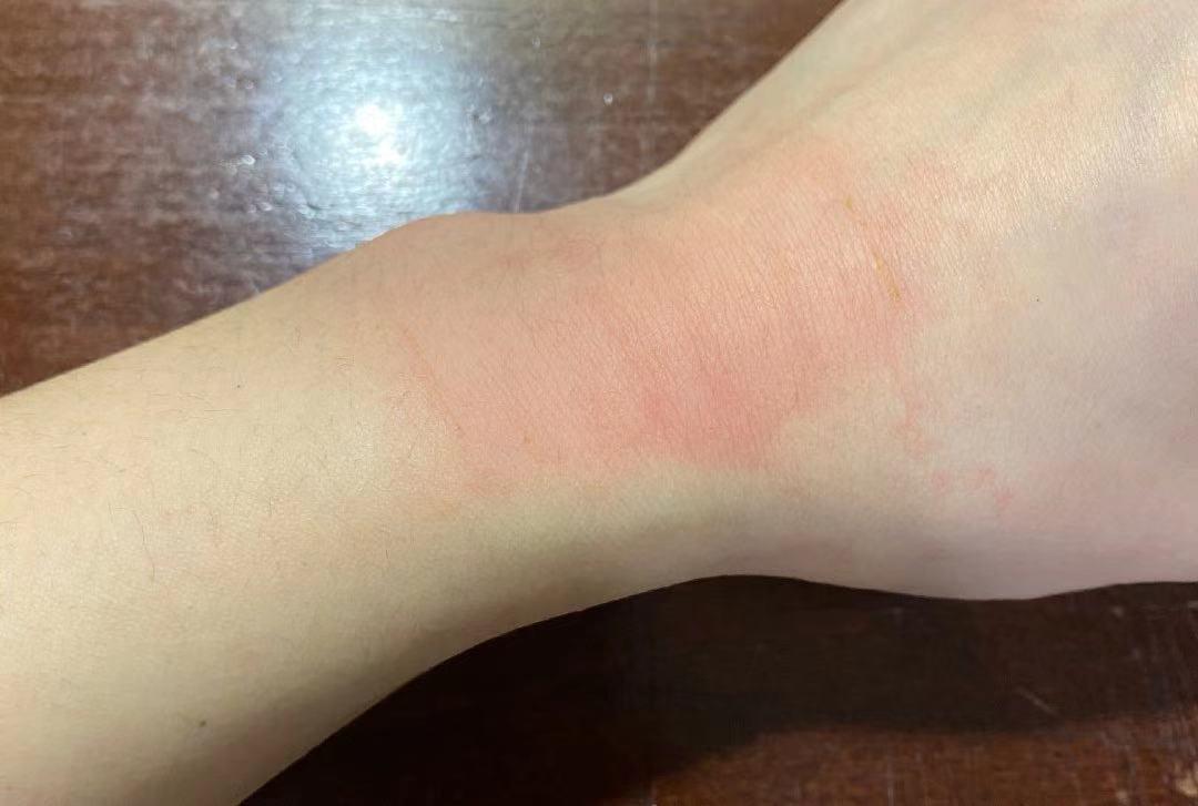 4种情况,真的不适宜贴膏药①过敏体质的人慎用制作膏药的药材中可能