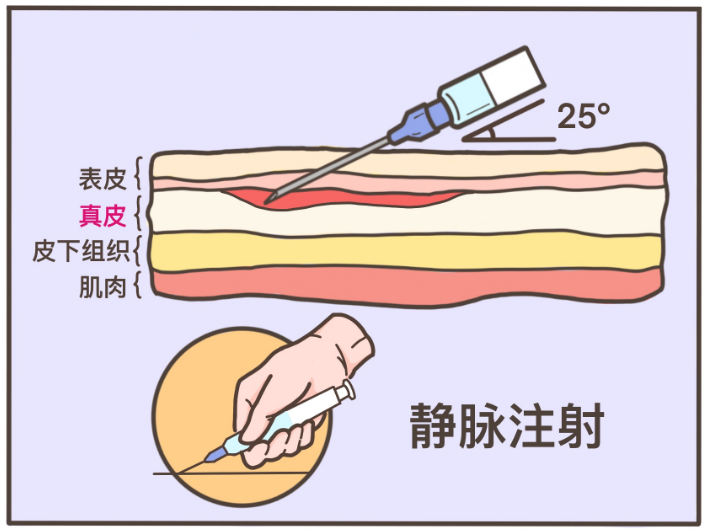 77 静脉注射,斜着扎进血管里请回想一下打青霉素前做的「皮试」,你
