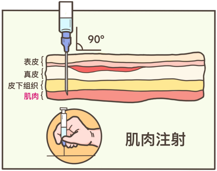 79 肌肉注射