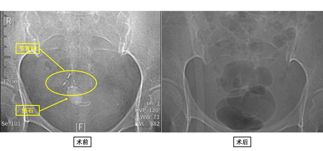 20多年前迷失的节育环竟然长出了膀胱结石