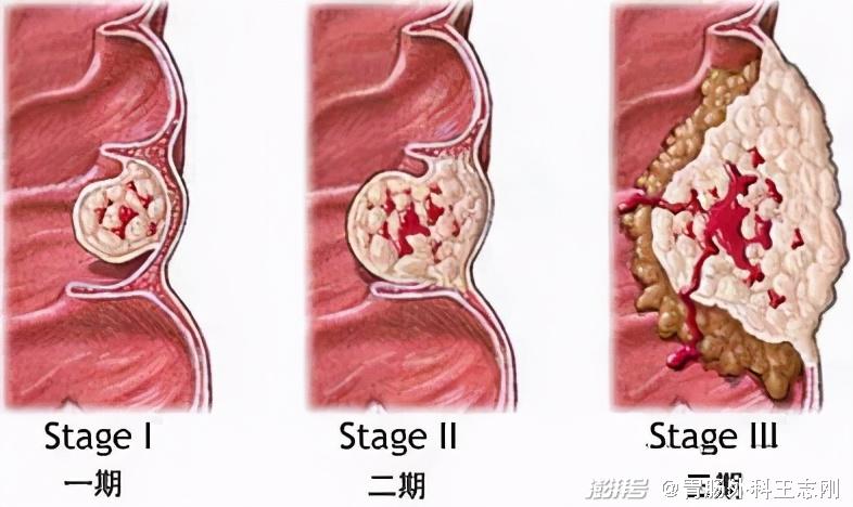 肠癌复发了还能再次手术吗