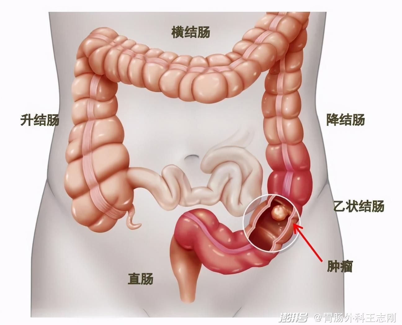 肠癌复发了还能再次手术吗