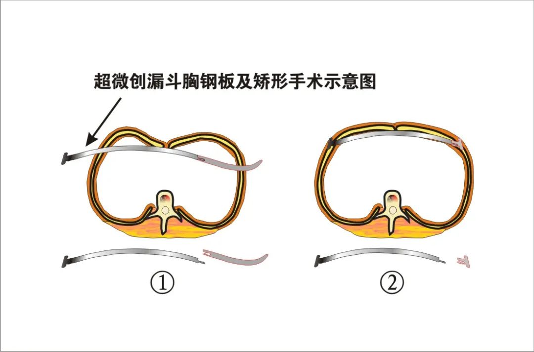 超微創漏斗胸矯治術前與術後對比新技術應用使九院胸外科在漏斗胸的