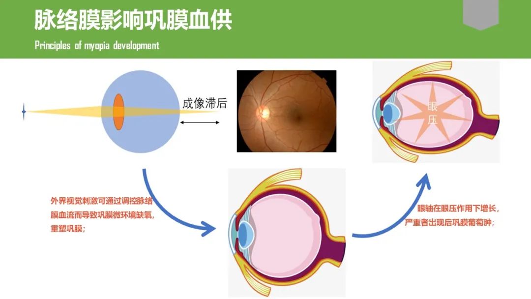 脉络膜增厚是怎么回事?好事还是坏事?