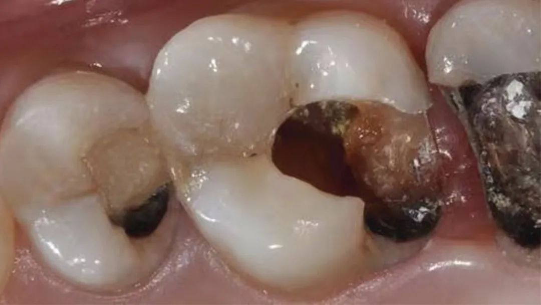 牙齿死亡全过程曝光