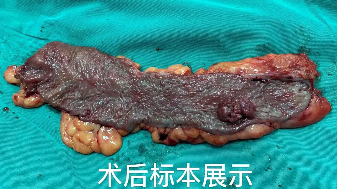 經自然腔道標本取出(noses)腹腔鏡乙狀結腸腫瘤切除術在我院尚屬首次