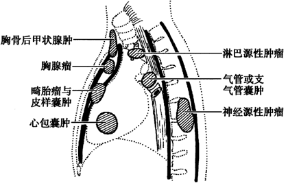 图为纵隔肿瘤的常见好发部位及种类2,纵隔干细胞肿瘤,以前叫生殖细胞