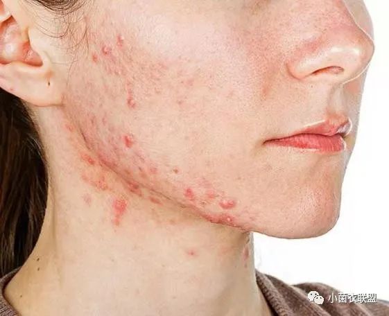 爆痘你莫怕为了青春战痘到底