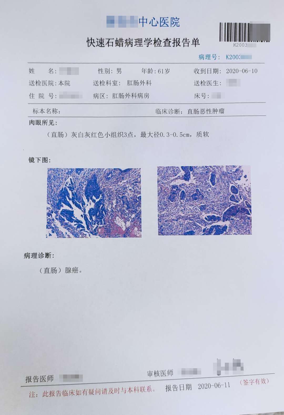 肠镜的结果如当头一棒,基本确定是直肠癌,但最后的确诊还要等病理结果