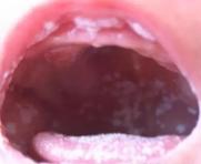 婴儿舌头上的奶垢图片图片