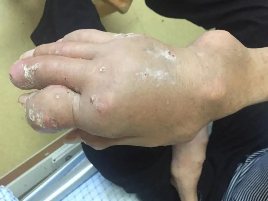 吓丨小伙手脚长满石头不幸截瘫这样的习惯很多人都有